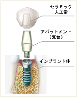 インプラントの構造